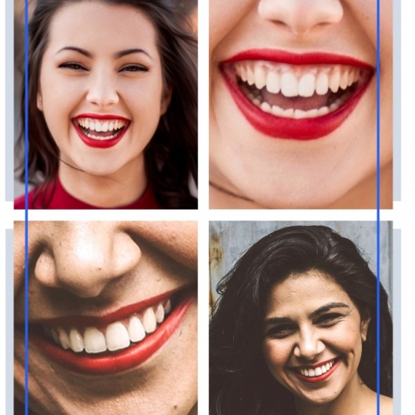 Sonrisa Gingival Rejuvenecimiento Facial Barcelona, Toxina Botulínica para mejorar Sonrisa Gingival